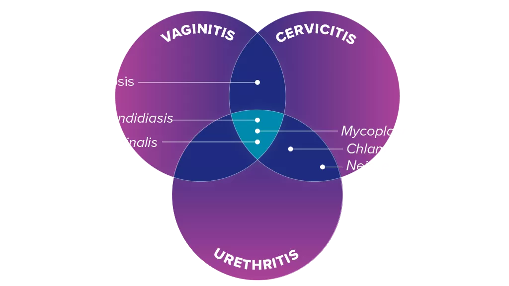 Overlapping illustration of Vaginitis Cervicitis Urethritis