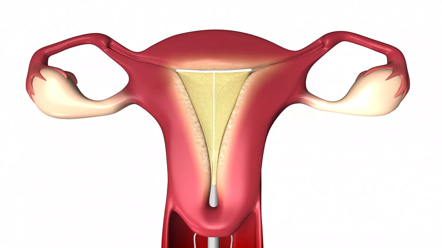 Medical illustration of the NovaSure instrument within the uterus.