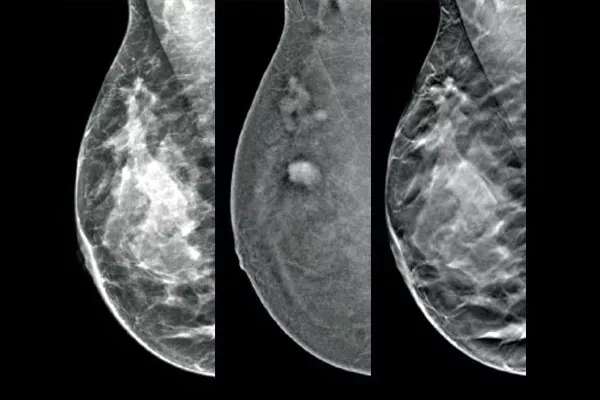 Three mammography images, a 2D image, an I-View SEM image and a 3D Slice