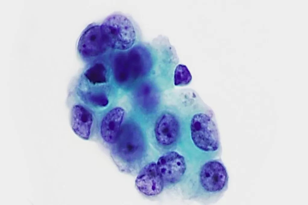 Adenocarcinoma, bronchial wash, Papanicolaou Stain